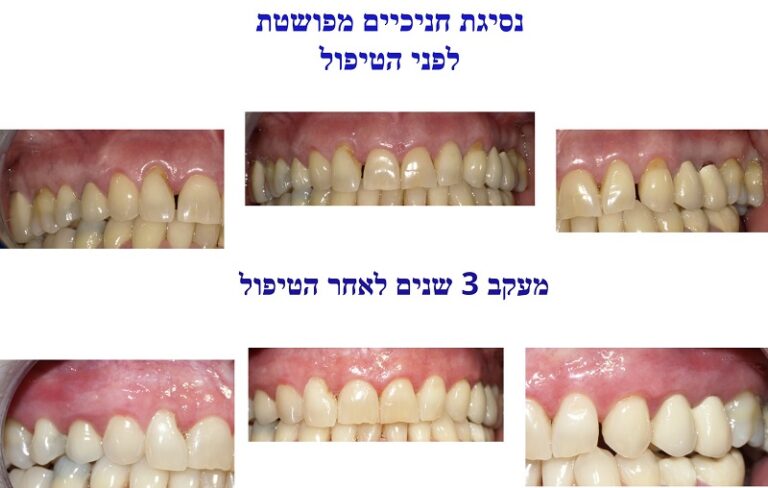 טיפול לסת עליונה ומעקב של 3 שנים לאחר הטיפול – רופא שיניים בבאר שבע ...